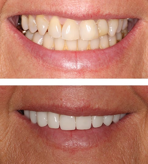 Fix_Dental_Before_After_Patient5 - Fix Dental