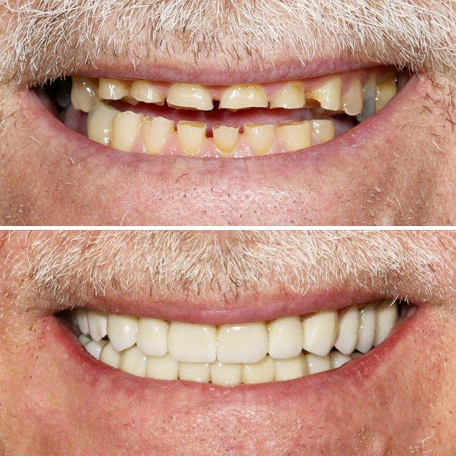 Dental Veneers | Fix Dental | Mount Gravatt & Chermside