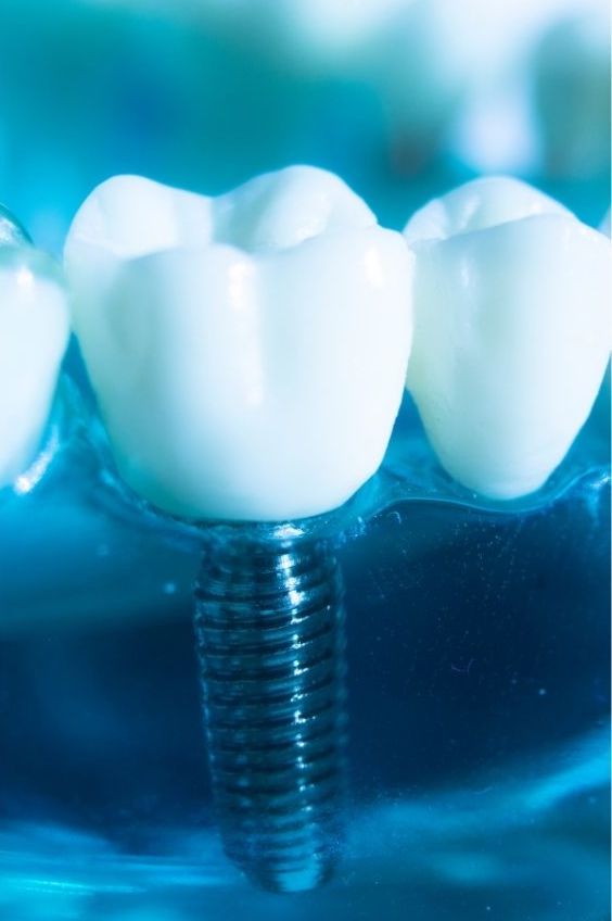 Dental Implants - Cost, Procedure and Pain | Fix Dental